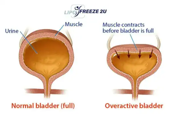 diagram of overactive bladder treatment Somerset