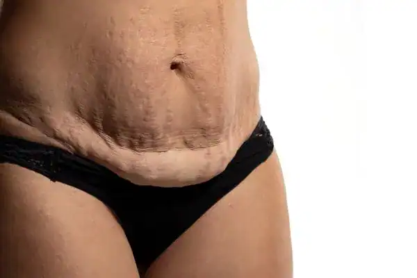 loose skin after weight loss injections Somerset