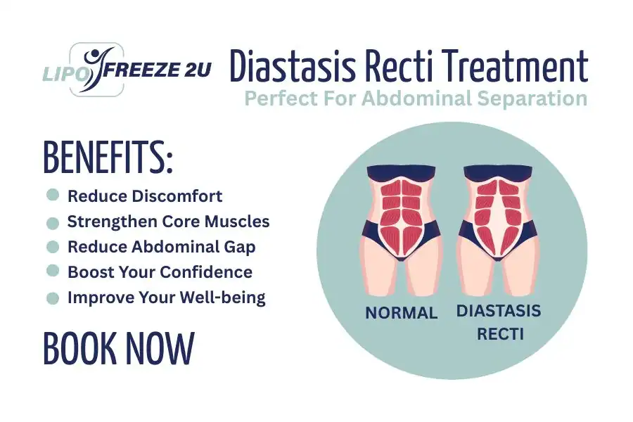 Benefits of body toning treatment Somerset for Diastasis recti