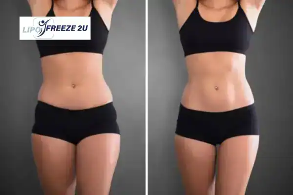 How Can LIPO FREEZE 2U Support Your Post-Pregnancy Body Recovery Somerset?