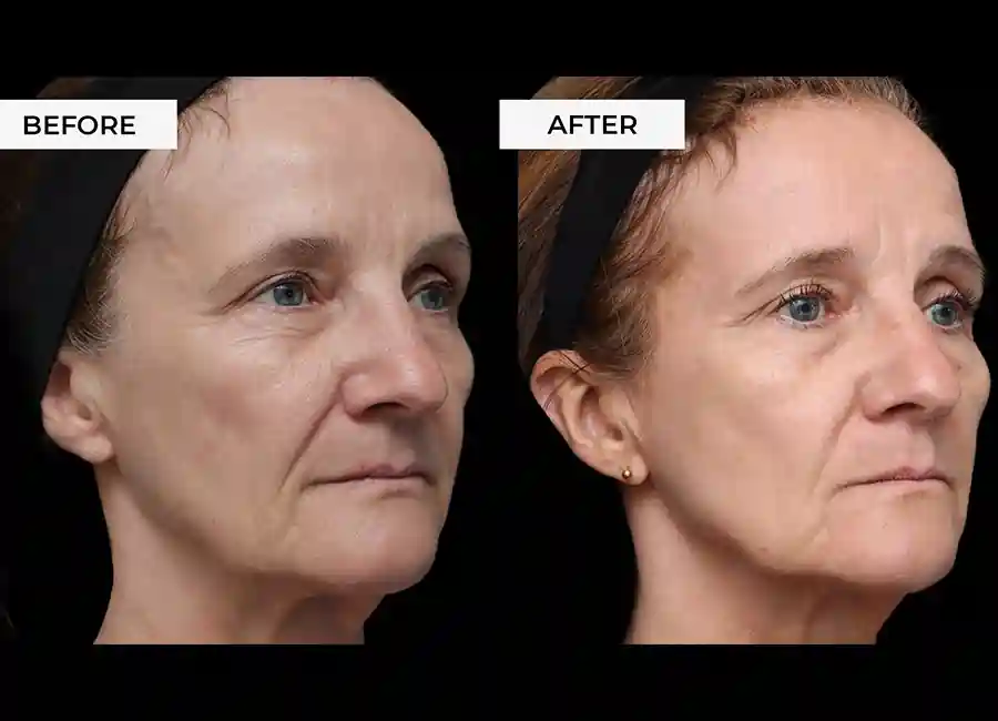 How Many RF Microneedling Sessions Will You Need to See a Difference Somerset?