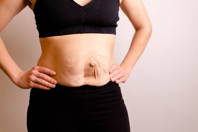 Is Surgery Really the Only Way to Repair Diastasis Recti Somerset?