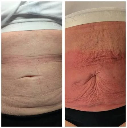 How Does RF Microneedling Improve Crepey, Thin and Uneven Skin Texture Somerset?