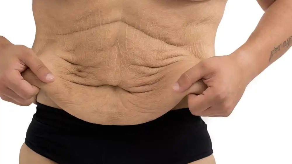 Why Does Weight Loss Medication Leave Some People With Loose or Sagging Skin Somerset?
